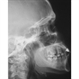 Intraocular Foreign Body Intraocular Foreign Body